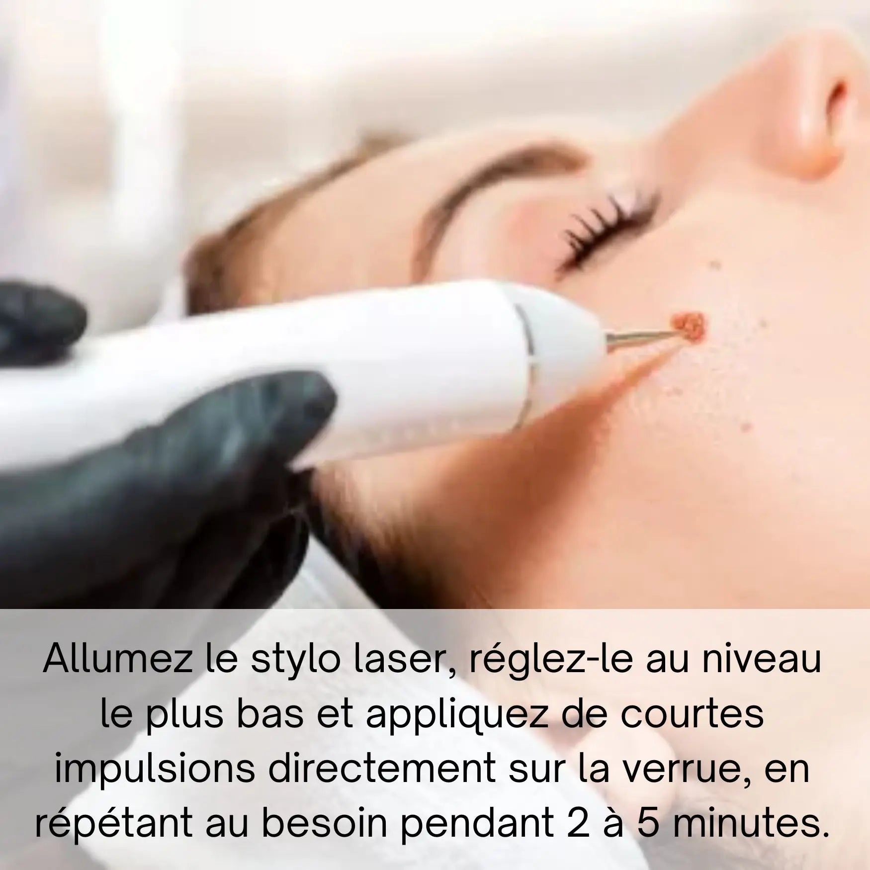 DermaLase™ | Éliminez les taches pigmentaires et les verrues sans douleur en seulement 3 jours