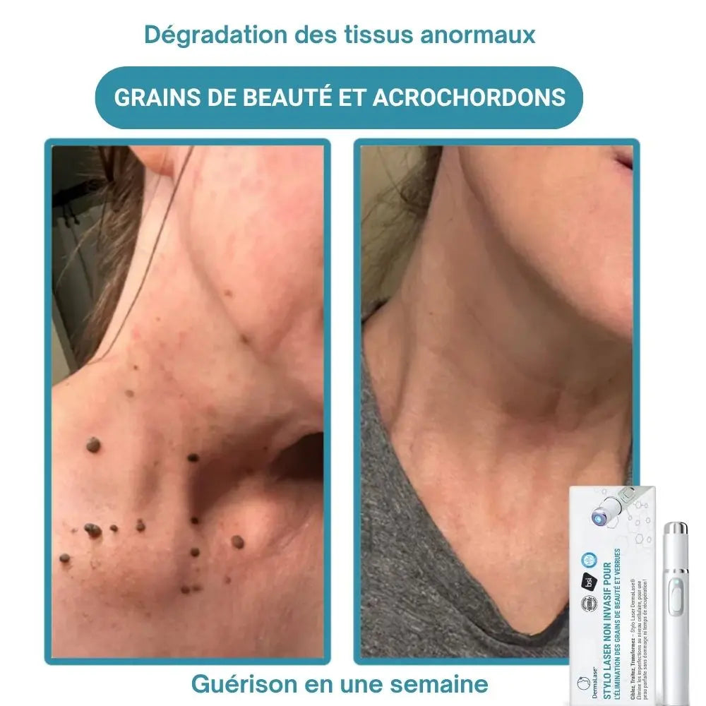 DermaLase™ | Éliminez les taches pigmentaires et les verrues sans douleur en seulement 3 jours
