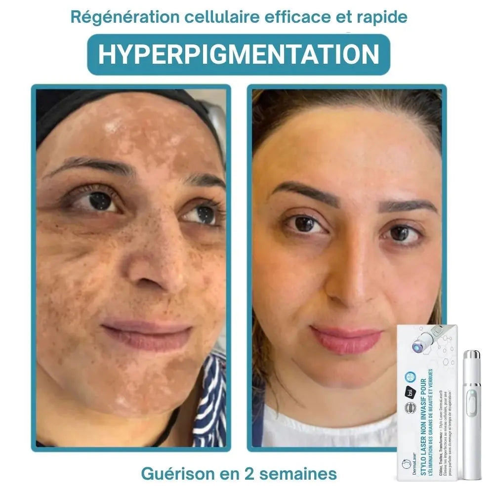 DermaLase™ | Éliminez les taches pigmentaires et les verrues sans douleur en seulement 3 jours
