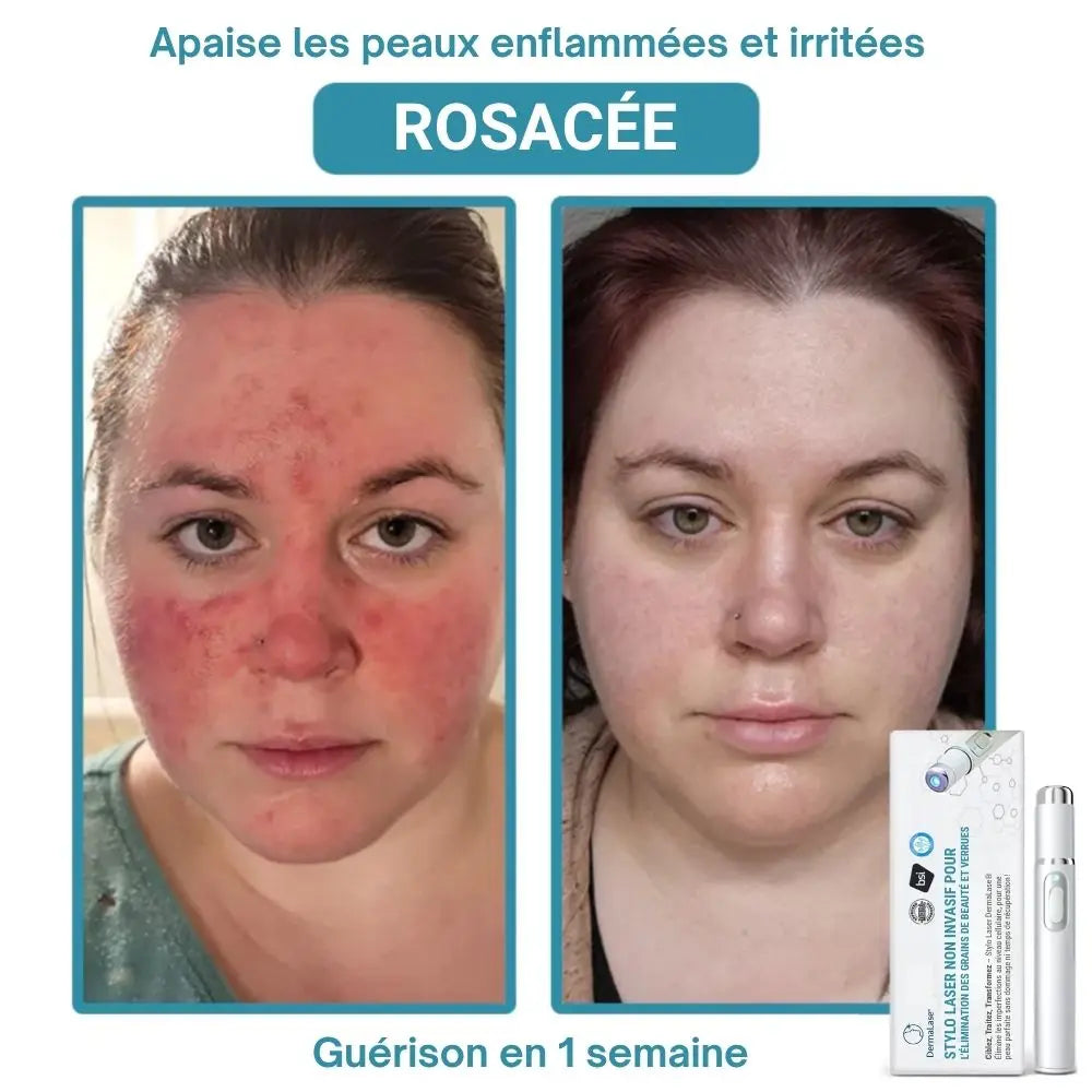 DermaLase™ | Éliminez les taches pigmentaires et les verrues sans douleur en seulement 3 jours
