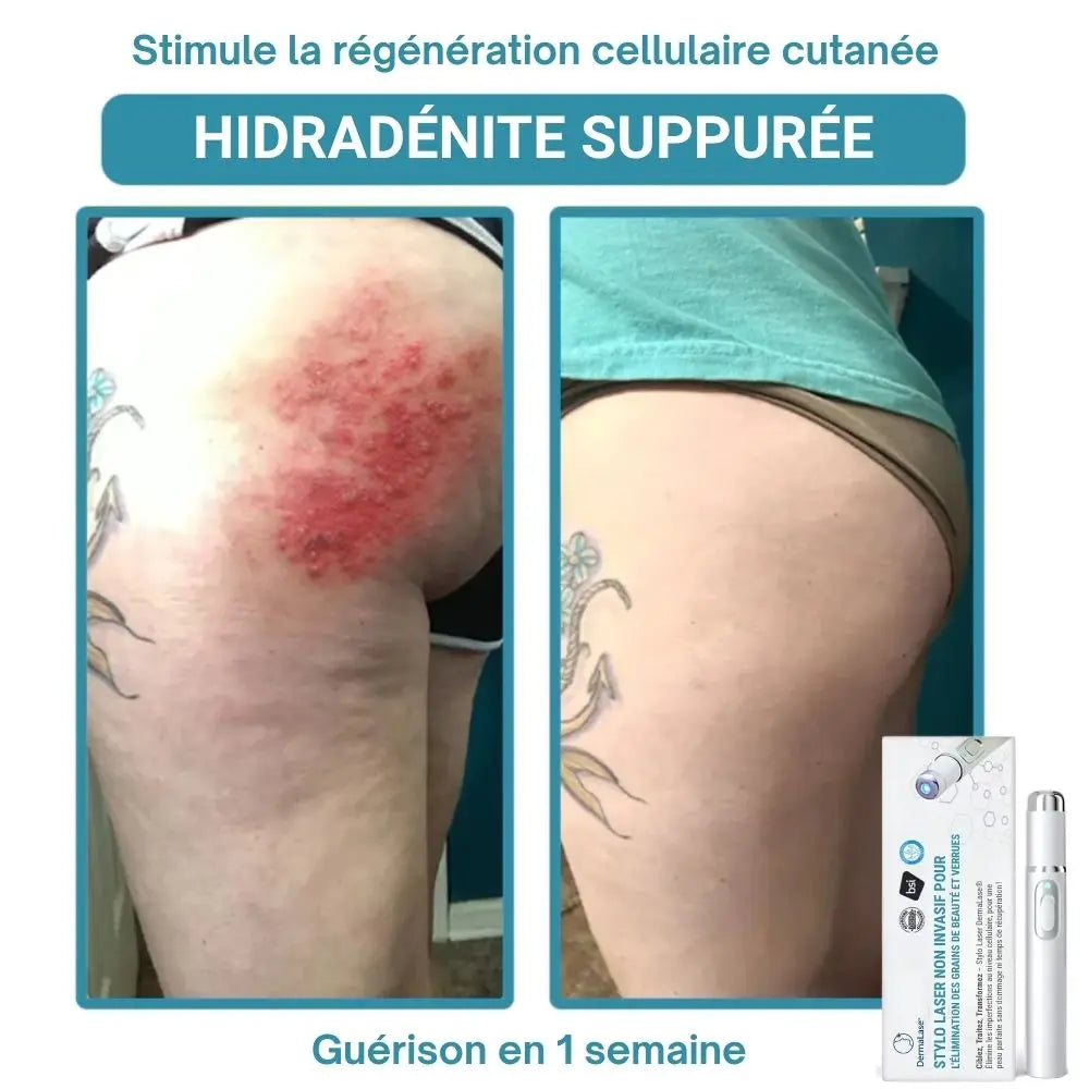 DermaLase™ | Éliminez les taches pigmentaires et les verrues sans douleur en seulement 3 jours